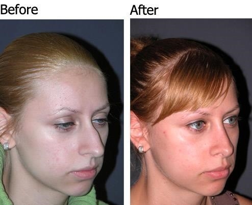 rhinoplasty surgeons