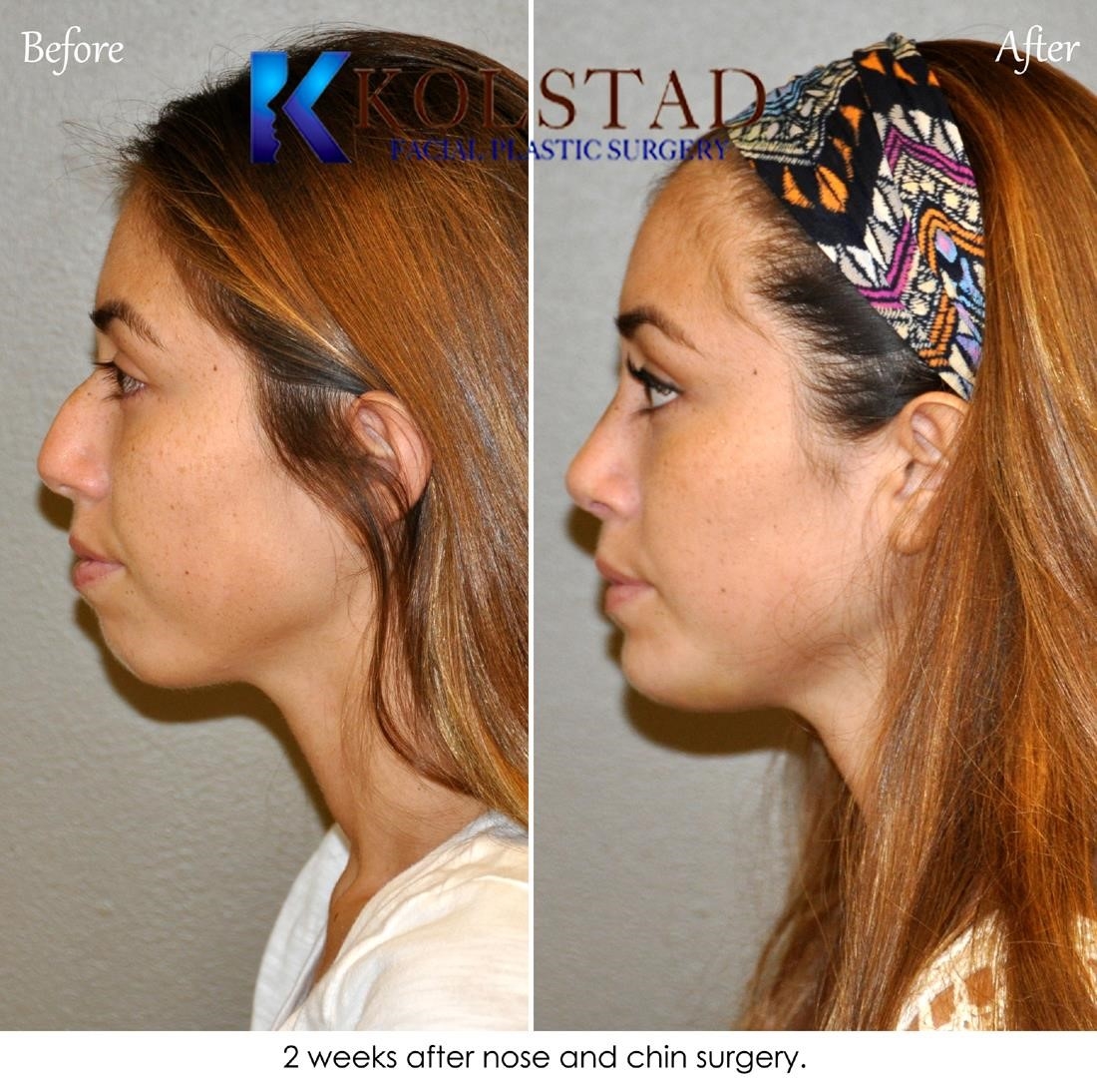 rhinoplasty surgeons